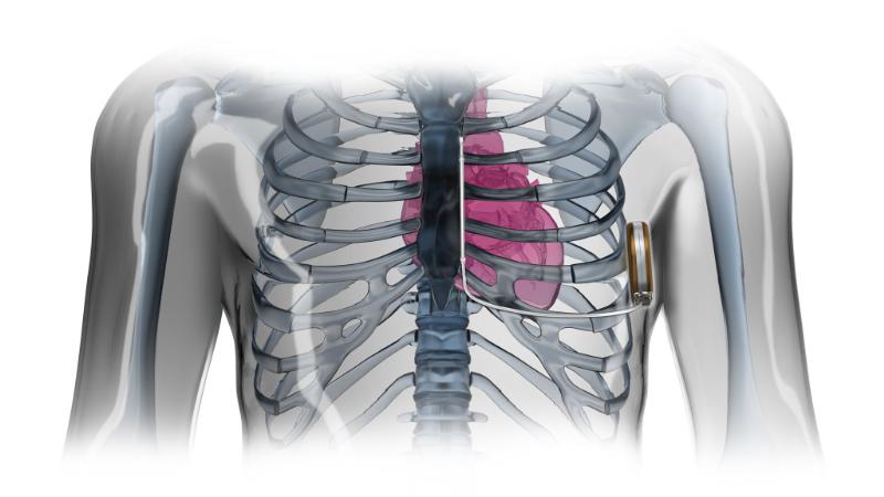 Boston Scientific Begins Expansion of S-ICD System in Asia | DAIC